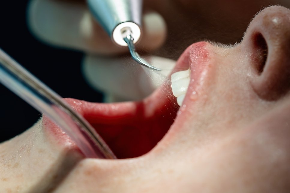 Odontologas atlieka danties plombavimo procedūrą su dentaliniu instrumentu