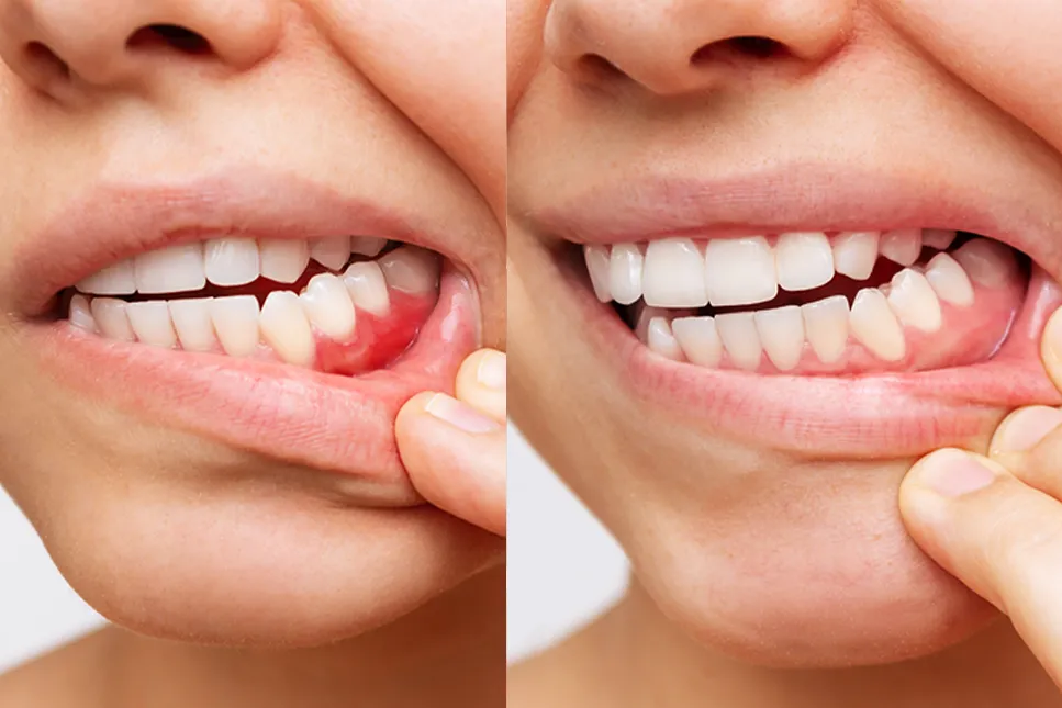 Dantenų būklės palyginimas prieš ir po peridontologinio gydymo – uždegiminės ir sveikos dantenos