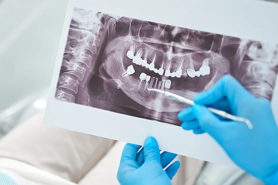 Odontologas su medicininėmis pirštinėmis rodo į paciento dantų panoraminę rentgeno nuotrauką