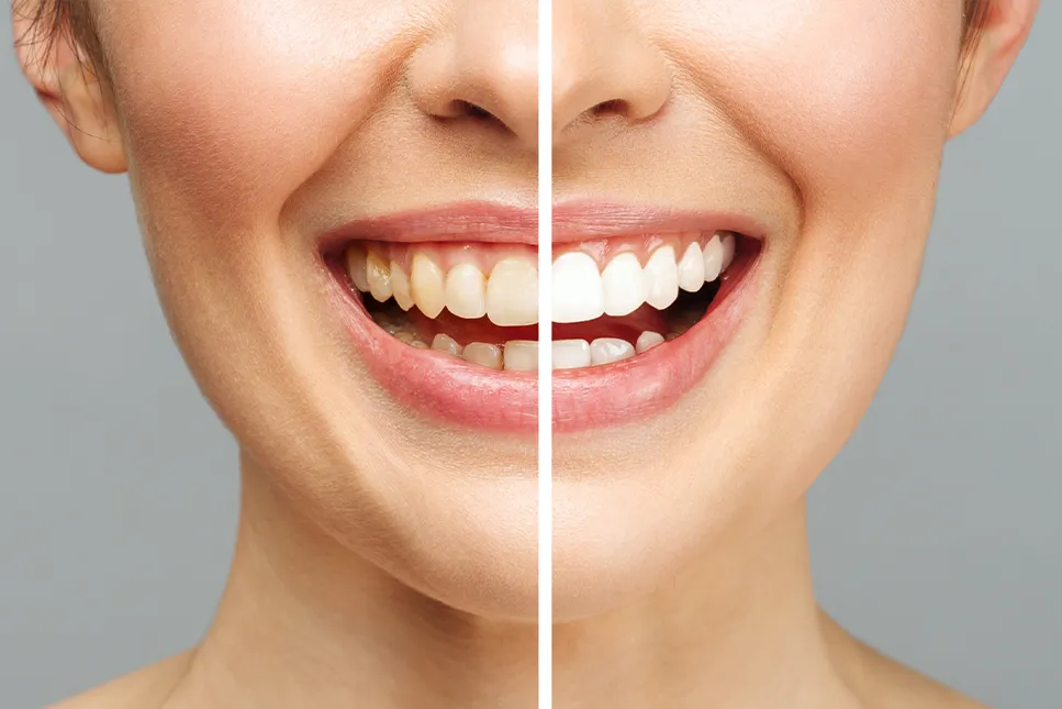 Dantų balinimo rezultatas prieš ir po procedūros, parodantis pagerėjusią dantų spalvą