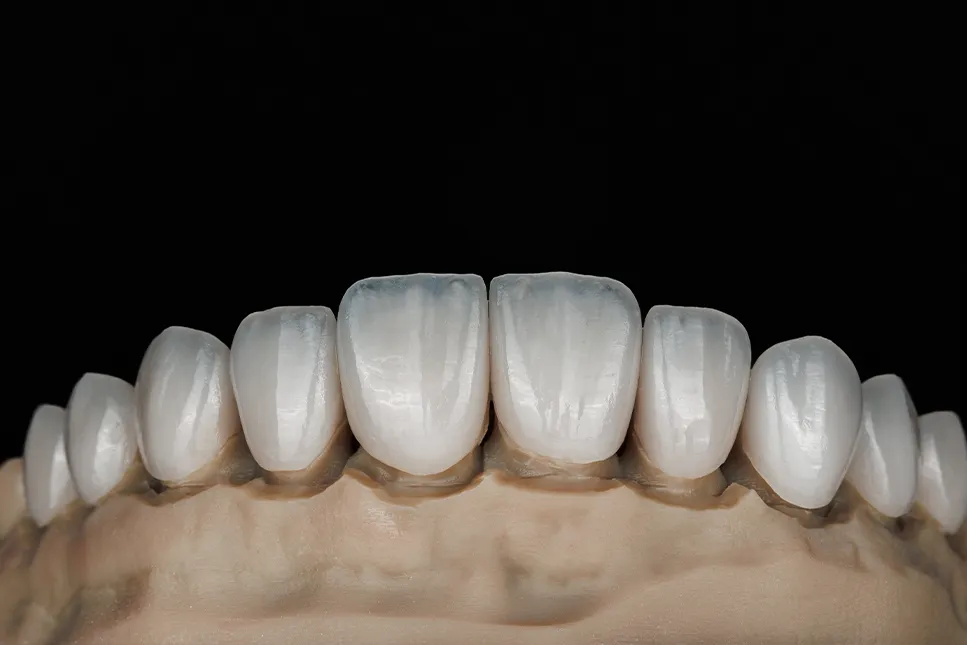 Keraminių estetinių laminatės (venyrai) uždėti ant dantų modelio, vaizduojamas galutinis estetinės restauracijos rezultatas