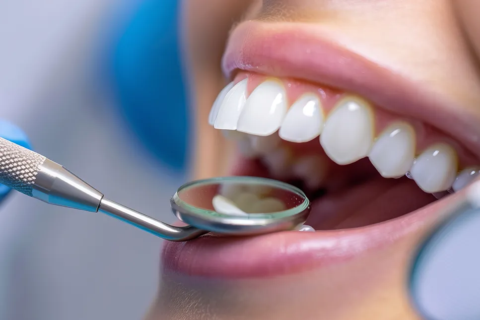 Odontologas naudoja dentalinį veidrodėlį dantų apžiūrai ir ICON sistemos procedūrai be gręžimo