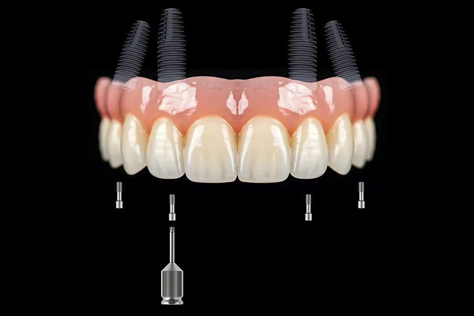 All-on-4 dantų implantų sistema