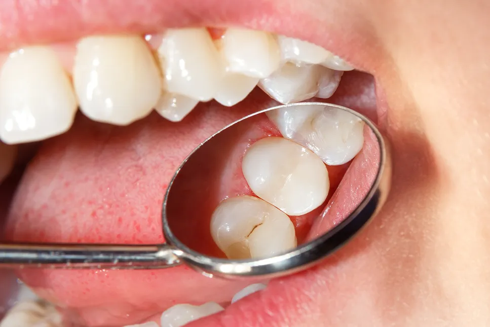 Dentalinis veidrodėlis naudojamas galinių dantų apžiūrai, matomas plombuotas krūminis dantis